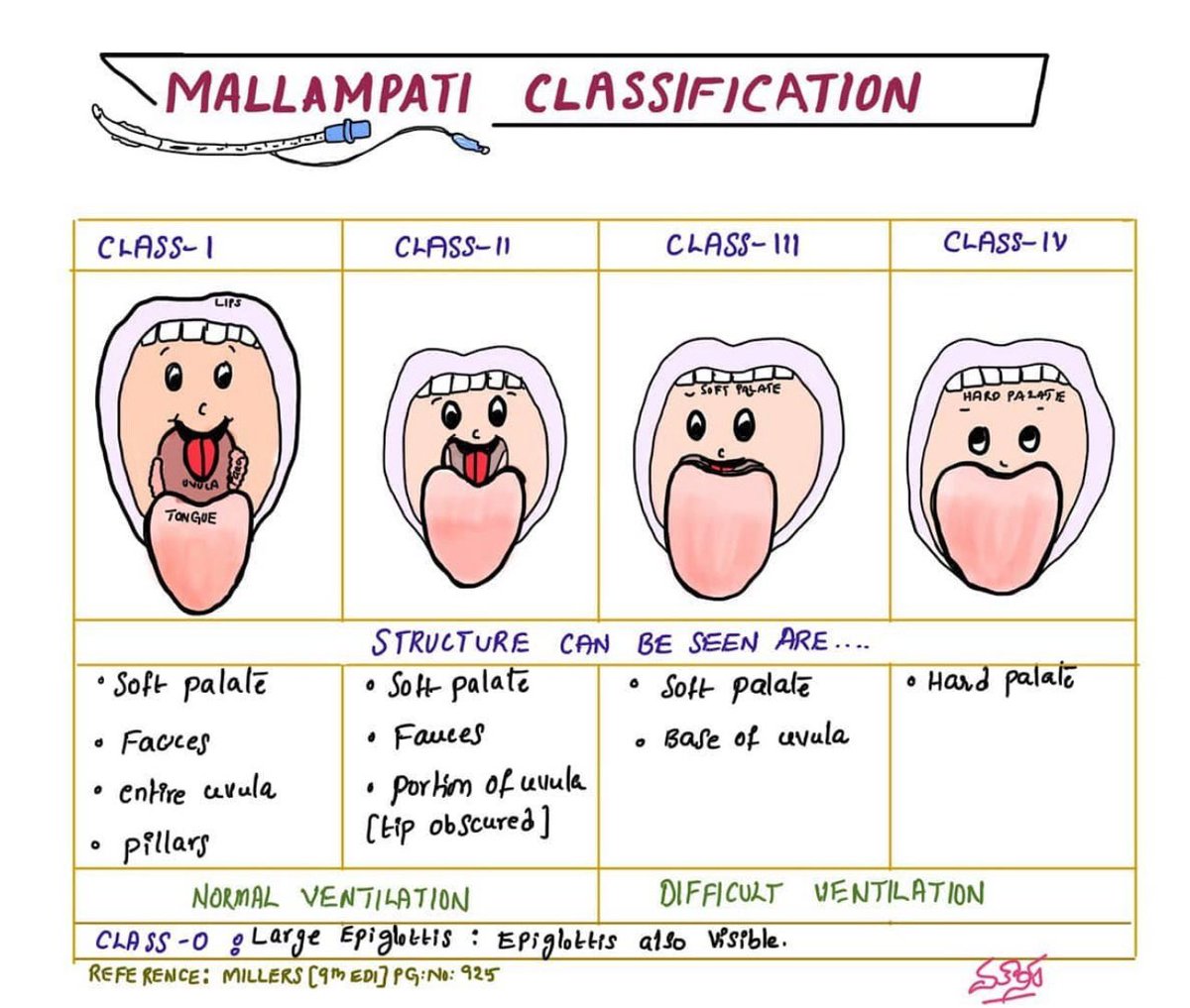 MALLAMPATI
CLASSIFICATION for assessing airways