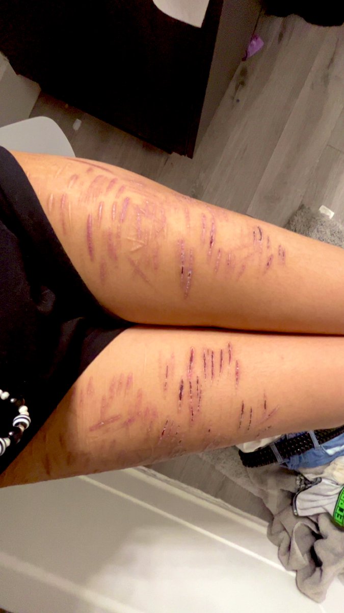 Ticcitoby__irl's tweet photo. ULTIMATE THIGH SCAR CHECK #babybeans #slittwt #deepstyros #shtwt https://t.co/wnqcbGm8Xb