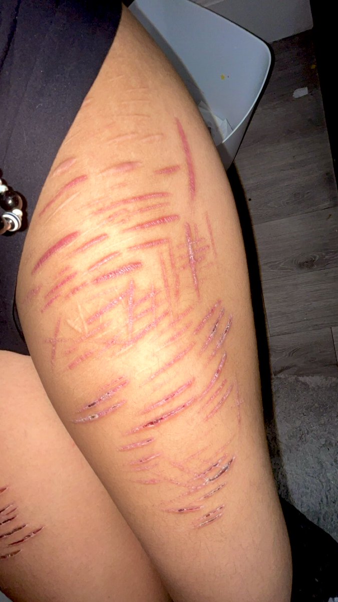 Ticcitoby__irl's tweet photo. ULTIMATE THIGH SCAR CHECK #babybeans #slittwt #deepstyros #shtwt https://t.co/wnqcbGm8Xb