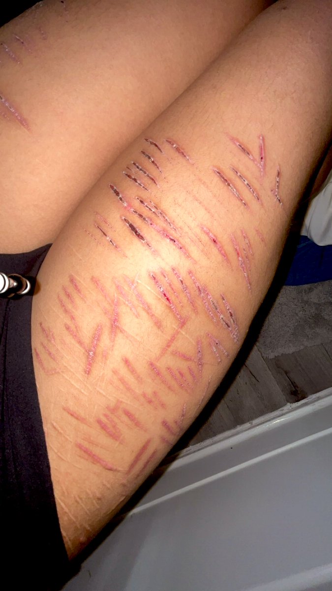 Ticcitoby__irl's tweet photo. ULTIMATE THIGH SCAR CHECK #babybeans #slittwt #deepstyros #shtwt https://t.co/wnqcbGm8Xb