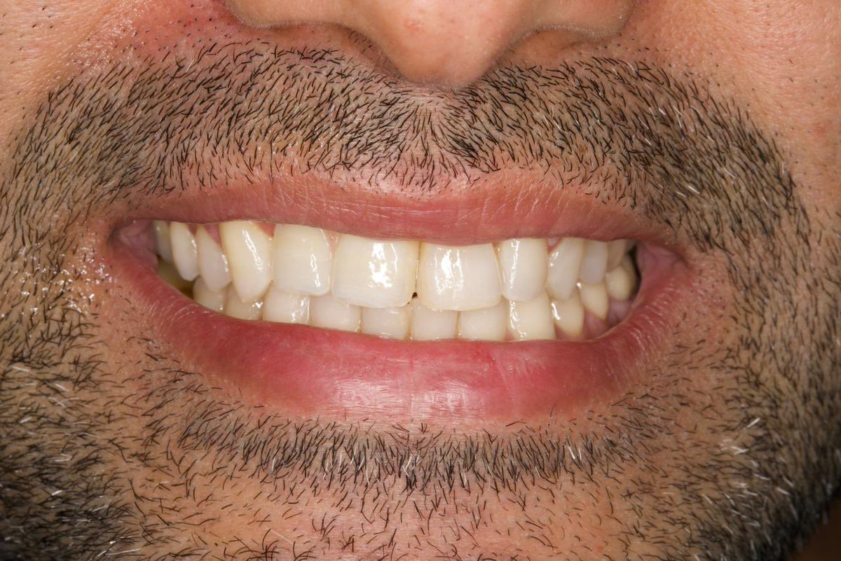 RB Straumann implant system.. @straumannglobal 
The patient has a missing front teeth .. The teeth were designed using CAD CAM and stained to match the shade of the patient’s adjacent teeth with gingival build up