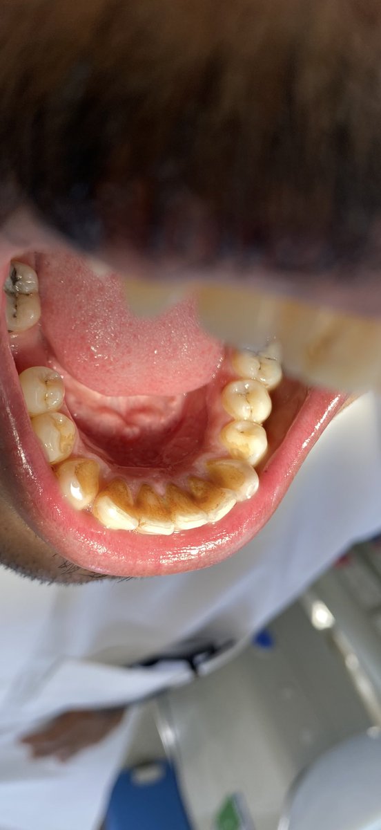 البقع الخارجية هي الأكثر شيوعًا لتصبغات الأسنان، وتظهر على السطح الخارجي بسبب عوامل مثل التدخين أو مضغ التبغ، تناول القهوة والشاي والأطعمة الملونة، وسوء العناية بالفم والأسنان ننصح المراجعين بزيارة أخصائي صحة الفم والأسنان لعلاج التصبغات، حيث يقوم الأخصائي بتقديم العلاج المناسب