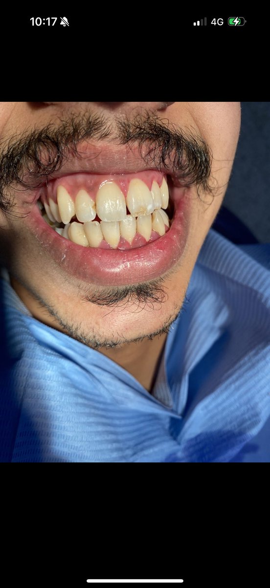 Some cases in internship involve calculus deposits gum inflammation and stains, with smoking being one of the main causes. The treatment includes scaling and polishing the teethalong with manual treatment of periodontal pockets and the use of a disinfectant to eliminate bacteria