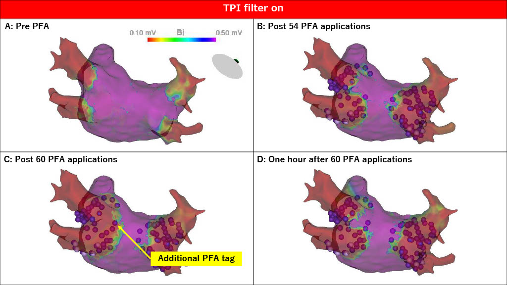 日本循環器学会 情報広報部会 (@jcirc_ipr) on Twitter photo This report demonstrates the possible utility of the tissue proximity indication feature integrated into the VARIPULSE catheter in predicting pulmonary vein reconnection.
By Haruka Matsuura, Tsukasa Kamakura (<a href="/KamakuraTsukasa/">Tsukasa Kamakura</a>)
doi.org/10.1253/circre…
#circ_rep #CardioX This report demonstrates the possible utility of the tissue proximity indication feature integrated into the VARIPULSE catheter in predicting pulmonary vein reconnection.
By Haruka Matsuura, Tsukasa Kamakura (<a href="/KamakuraTsukasa/">Tsukasa Kamakura</a>)
doi.org/10.1253/circre…
#circ_rep #CardioX