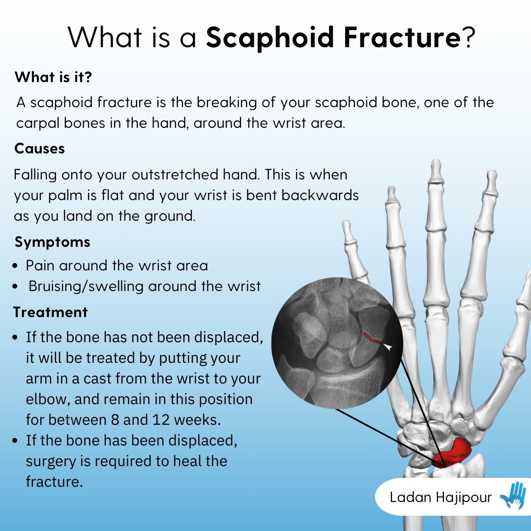 A scaphoid fracture is a break in the scaphoid bone, which is located in the wrist, near the base of the thumb. 🫷🦴

If you are suffering from a scaphoid fracture, click the link to book an appointment 👇 ladanhajipour.com/book-appointme…

#ScaphoidFracture #Fractures