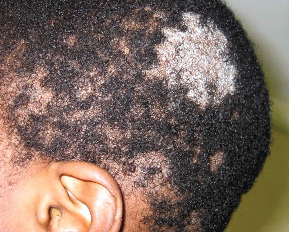 safonyameherbal's tweet photo. For TINEA CAPITIS and RING WORM, scratch the affected part with dry sponge, make a paste of the leave or roots of Cassia occidentalis( negro coffee, mmofraborodee in Twi, rere or yawan rai in yoruba) and apply on the on the affected part twice daily 🍀.. it disappears in a week🤝 https://t.co/asCakPB9Ry