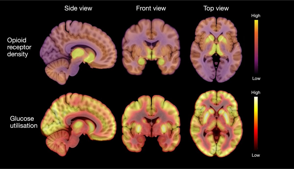 Our new <a href="/TurkuPETCentre/">Turku PET Centre</a>  paper shed light on the neuromolecular mechanisms of anorexia nervosa - one of the most difficult and persistent psychiatric disorders. We propose that opioid dysfunction may be a key mechanisms in the lowered appetite and mood: utu.fi/en/news/press-…