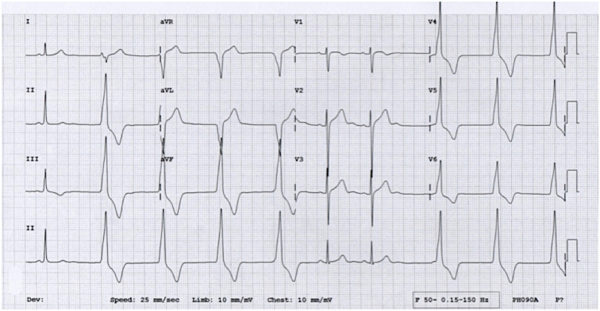 LITFL (@litflblog) on Twitter photo Marathon runner + acute gastroenteritis = ECG puzzle litfl.com/marathon-relat…
#FOAMed #MedEd #MedTwitter #CardioTwitter Marathon runner + acute gastroenteritis = ECG puzzle litfl.com/marathon-relat…
#FOAMed #MedEd #MedTwitter #CardioTwitter