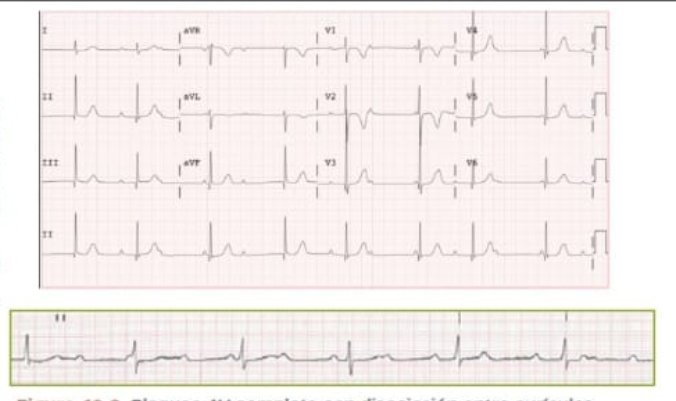 ECG interesante 💡

🍳 Recién salido del examen #MIR2025 

(Aprovechamos para desear suerte🍀 a todos los aspirantes que quieran coger #cardio! 🫀)

Qué les llama la atención? 🧐