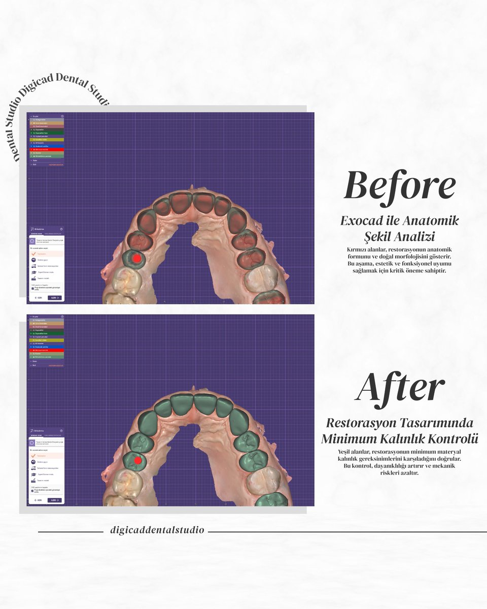 DigicadDental's tweet photo. 🦷Hastalarınıza en iyi sonuçları sunmak için yanınızdayız! 💎#DigicadDentalStudio, estetik ve fonksiyonel restorasyonlarda kaliteyi ve hassasiyeti bir araya getiriyor.
📞 İletişim: 0505 648 18 93
•
#AnkaraDişLaboratuvarı #ProtezDiş #DijitalDişTasarımı #ZirkonyumDiş #MetalProtez https://t.co/0W9vWMZ2uu