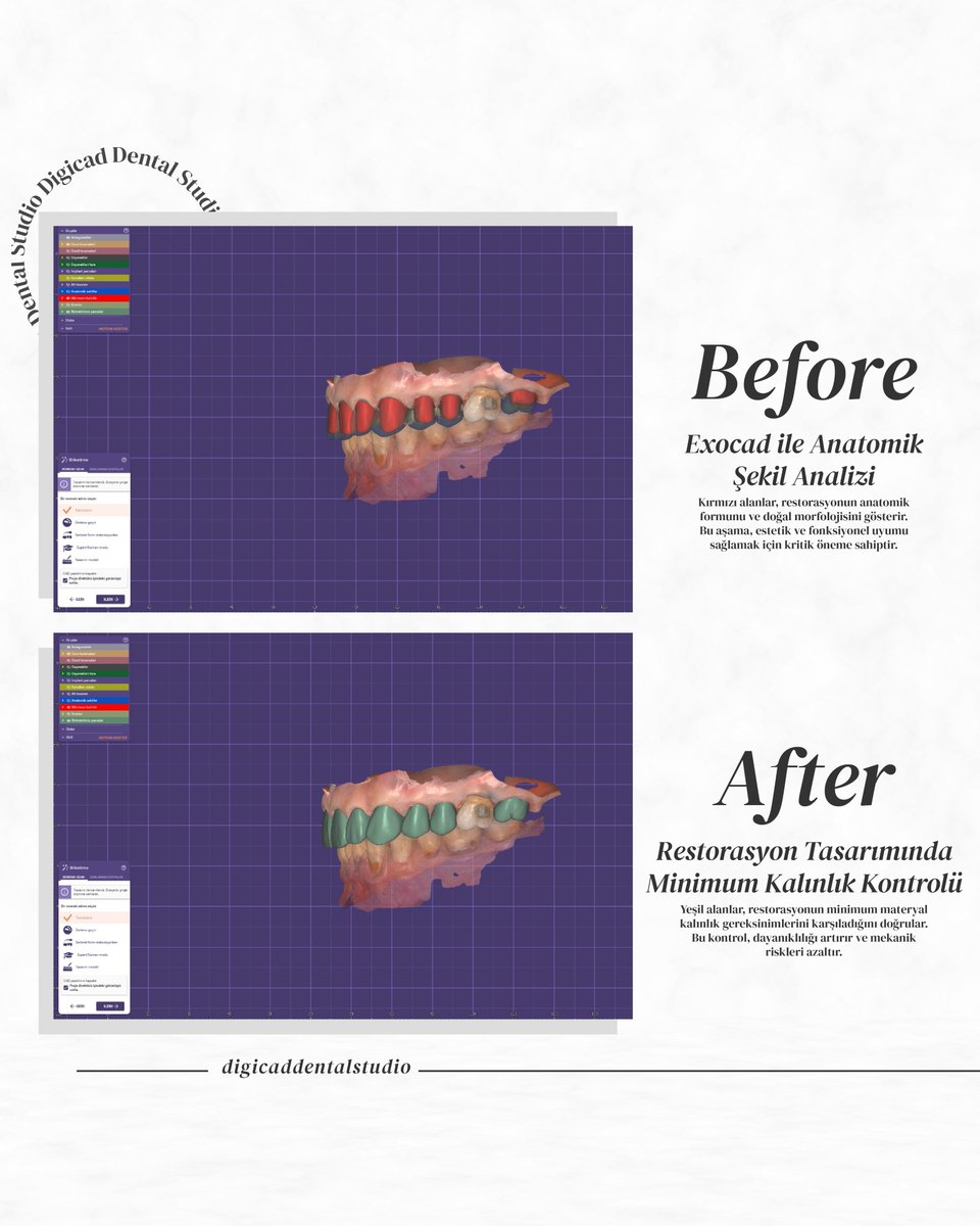 DigicadDental's tweet photo. 🦷Hastalarınıza en iyi sonuçları sunmak için yanınızdayız! 💎#DigicadDentalStudio, estetik ve fonksiyonel restorasyonlarda kaliteyi ve hassasiyeti bir araya getiriyor.
📞 İletişim: 0505 648 18 93
•
#AnkaraDişLaboratuvarı #ProtezDiş #DijitalDişTasarımı #ZirkonyumDiş #MetalProtez https://t.co/0W9vWMZ2uu