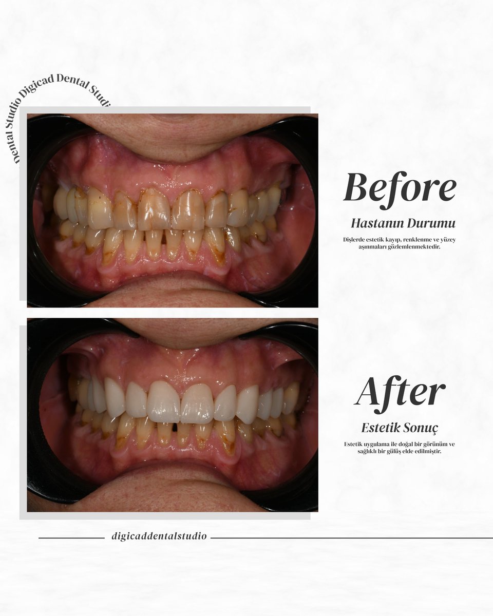 DigicadDental's tweet photo. 🦷Hastalarınıza en iyi sonuçları sunmak için yanınızdayız! 💎#DigicadDentalStudio, estetik ve fonksiyonel restorasyonlarda kaliteyi ve hassasiyeti bir araya getiriyor.
📞 İletişim: 0505 648 18 93
•
#AnkaraDişLaboratuvarı #ProtezDiş #DijitalDişTasarımı #ZirkonyumDiş #MetalProtez https://t.co/0W9vWMZ2uu