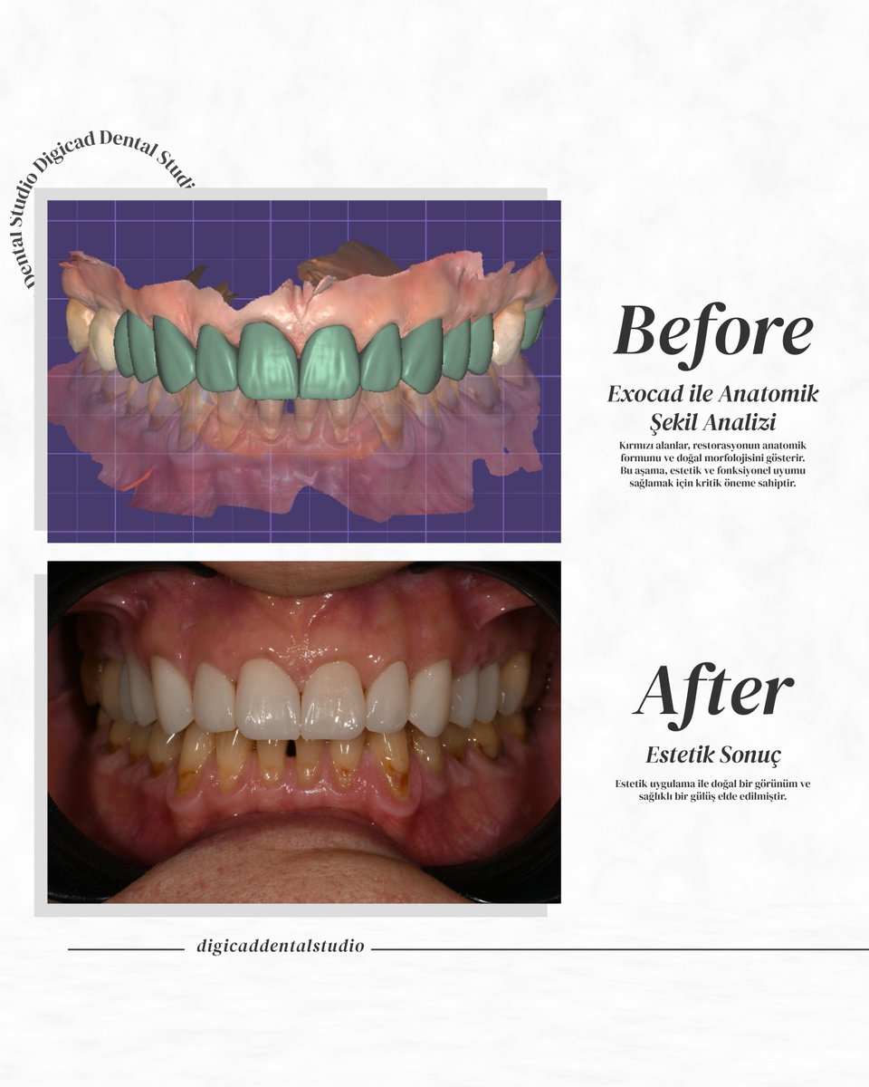 DigicadDental's tweet photo. 🦷Hastalarınıza en iyi sonuçları sunmak için yanınızdayız! 💎#DigicadDentalStudio, estetik ve fonksiyonel restorasyonlarda kaliteyi ve hassasiyeti bir araya getiriyor.
📞 İletişim: 0505 648 18 93
•
#AnkaraDişLaboratuvarı #ProtezDiş #DijitalDişTasarımı #ZirkonyumDiş #MetalProtez https://t.co/0W9vWMZ2uu