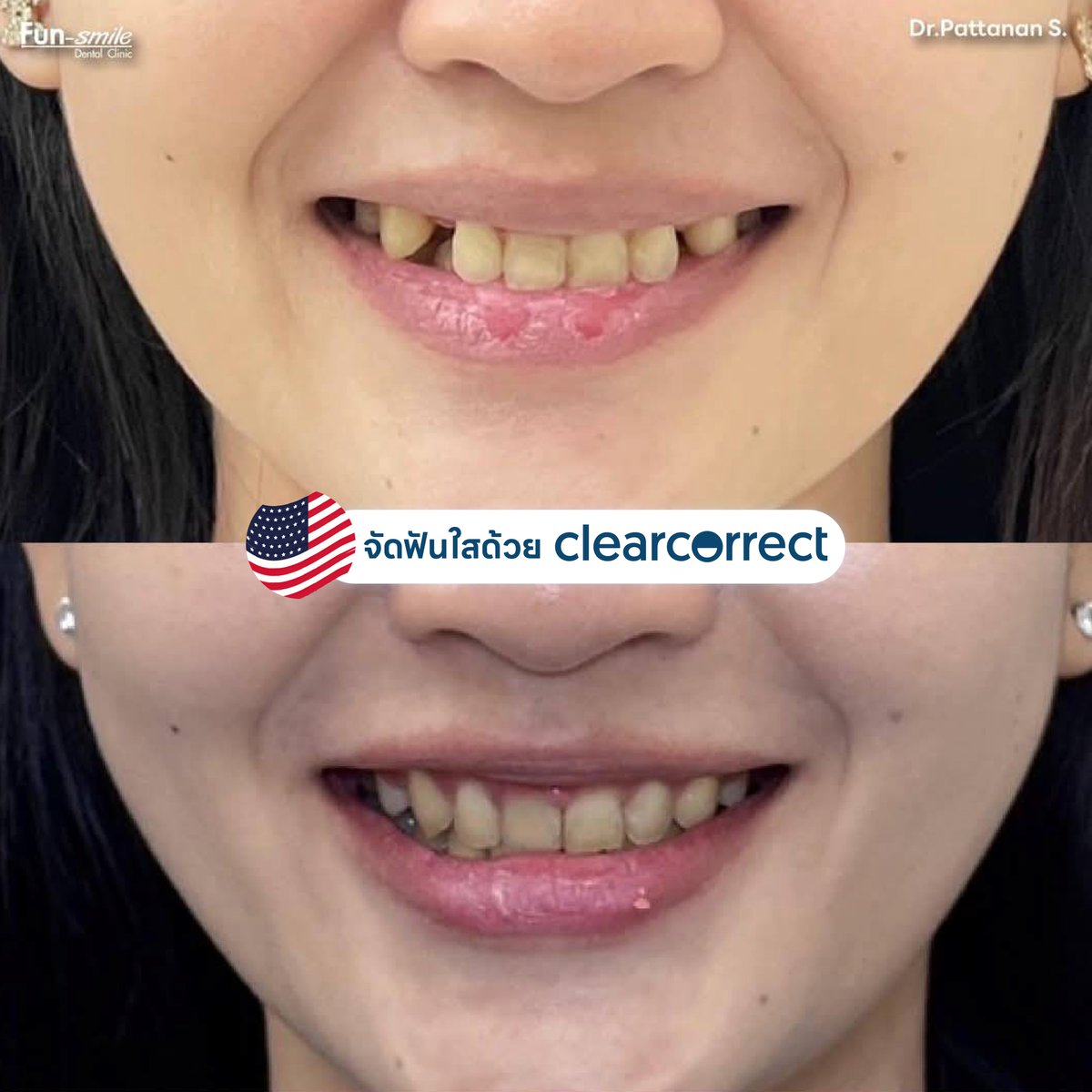 👉จัดฟันใสแก้ฟันยื่น 49,000 แถมฟรีรีเทนเนอร์ USA 🇺🇸มูลค่า 5,000 คุ้มสุดๆ💯
✅️แก้ปัญหาฟันหน้าที่ห่างชิด ช่องว่างปิดหมด
✅️ฟันบนหุบเข้า ฟันหายยื่น
✅️ฟันหน้าล่างเรียงเนียนกริบ หายซ้อนเก

Clearcorrect by Straumann ที่มีนวัตกรรมวัสดุจัดฟันใสที่ช่วยเคลื่อนฟันไปตามที่หมอออกแบบได้100% และขอบคุณคนไข้ที่มีวินัยในการใส่ชิ้นงานอย่างดีเยี่ยม
อยากฟันเข้าเร็วๆ เรียงสวย ไม่อืดอาด หมอยินดีให้คำปรึกษาทุกเคสค่า😘

🙏🏻ขอบพระคุณที่เชื่อในฝีมือหมอและไว้วางใจให้ฟันสไมล์ดูแลรอยยิ้มนะคะ💕
╔═══════ ════ ════╗
👇อยากปรึกษาจัดฟันใส  จิ้มเลย👇
https://t.co/w7PV7Kz6tp
https://t.co/hhNIAvh8zz
╚════════════════╝
คลินิกฟันสไมล์ โคราชมี 3 สาขานะคะ
ใกล้ที่ไหนไปที่นั่นได้เลยน๊าาา
https://t.co/CHAzPTeo9X
╔═══════════╗
สาขา 1 ในเมือง ถ.อัษฎางค์
☎️ 099-159-3500
เ ส้ น ท า ง ม า ส า ข า 1
https://t.co/UM5mHIWNBK
╚═══════════╝
╔═══════════╗
สาขา ชั้นใต้ดิน เดอะมอลล์โคราช
☎️ 095-145-9556
เ ส้ น ท า ง ม า ส า ข า เดอะมอลล์
https://t.co/7gAduc3vCe
╚═══════════╝
╔═══════════╗
สาขา 3 ในตลาดเซฟวัน
☎️ 086-381-7711
เ ส้ น ท า ง ม า ส า ข า 3
https://t.co/mt3WiHsN3A
╚═══════════╝
#จัดฟันใส #จัดฟันใสโคราช  #จัดฟันแบบใส #invisalign  #clearcorrect  #วีเนียร์ #วีเนียร์โคราช #ฟอกสีฟัน #ฟอกฟันขาว #รากฟันเทียม #รากฟันเทียมโคราช #straumann #จัดฟัน #จัดฟันเหล็ก #จัดฟันโคราช #วีเนียร์ฉีด #ALLON4 #ALLON6 #ALLONX #overdenture #airflow #GBT #zoom #เลเซอร์เหงือก #ปลูกเหงือก #vista #CTG
#neodent