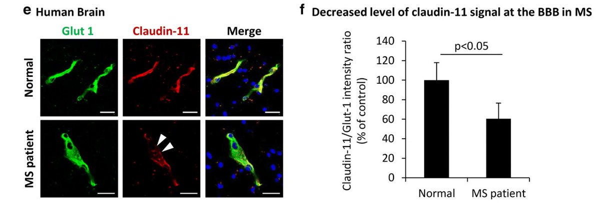 amansingh_96's tweet photo. Downregulation of claudin-11 in a MS patient's BBB and blood-spinal cord barrier (BSCB):

A 64-year old MS patient's brain and spinal cord was used to explore claudin-11 expression. In three BBB and BSCB capillaries of the MS patient, there was a significant reduction of claudin-11 expression. (6/7)