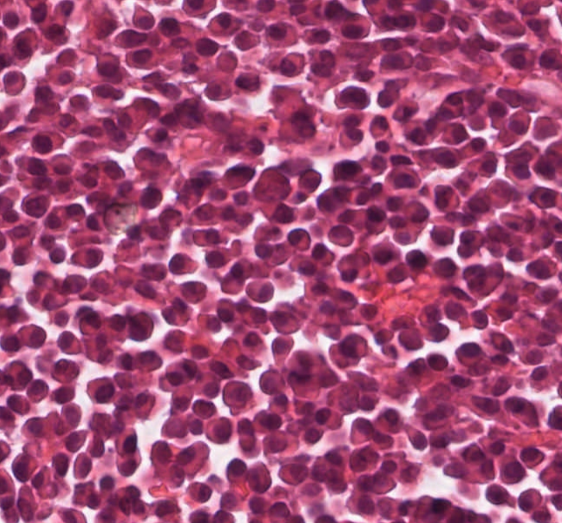 What neoplasm is causing this clavicular mass in a 65 year old man? View the whole slide on the Leeds Virtual Pathology Website here 🔬🔬🔬virtualpathology.leeds.ac.uk/slides/library… #softtissuepath #pathX #caseoftheweek