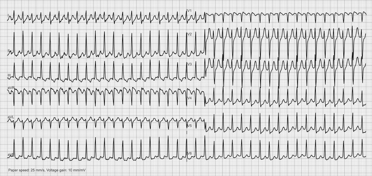 27 yo woman with palpitations; what`s your take?