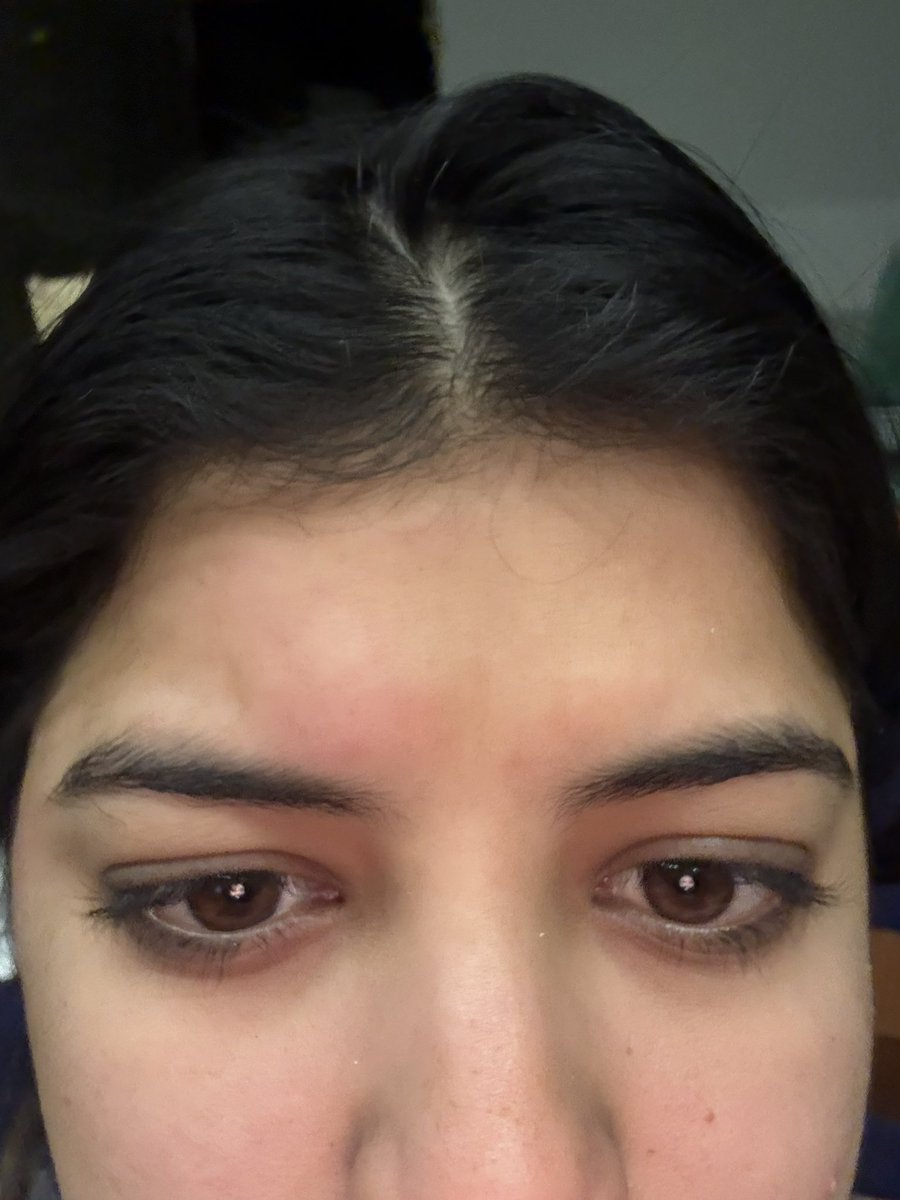 chenymittal's tweet photo. Used Omnibalm by @Cipla_Global today for a bad headache. After a few hours, I saw terrible swelling on my entire forehead. I have attached photos and videos as proof. 

Nobody should use this terrible balm. @Cipla_Global from your knowledge guide me as to what should I do now? https://t.co/030ZqctDOb