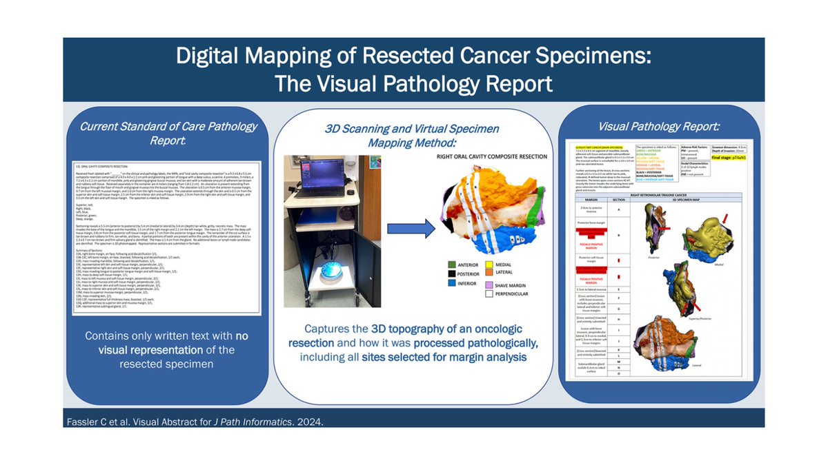 VUMC Otolaryngology–Head and Neck Surgery (@vanderbiltent) on Twitter photo *Incorporating 3D visual #Pathology reports for H&N cancer improves communication and reduces report length. Each report integrates 3D scans, tumor details, & diagnoses in a single page. <a href="/fassler_carly/">Carly Fassler</a> <a href="/marina_aweeda/">Marina Aweeda</a> <a href="/langermology/">Alexander Langerman (he/him) 🏳🌈🇺🇦🇺🇸</a> <a href="/EbenRosenthal/">Eben L Rosenthal, MD</a> <a href="/TopfHNS/">Michael Topf MD, MSCI</a>
sciencedirect.com/science/articl… *Incorporating 3D visual #Pathology reports for H&N cancer improves communication and reduces report length. Each report integrates 3D scans, tumor details, & diagnoses in a single page. <a href="/fassler_carly/">Carly Fassler</a> <a href="/marina_aweeda/">Marina Aweeda</a> <a href="/langermology/">Alexander Langerman (he/him) 🏳🌈🇺🇦🇺🇸</a> <a href="/EbenRosenthal/">Eben L Rosenthal, MD</a> <a href="/TopfHNS/">Michael Topf MD, MSCI</a>
sciencedirect.com/science/articl…