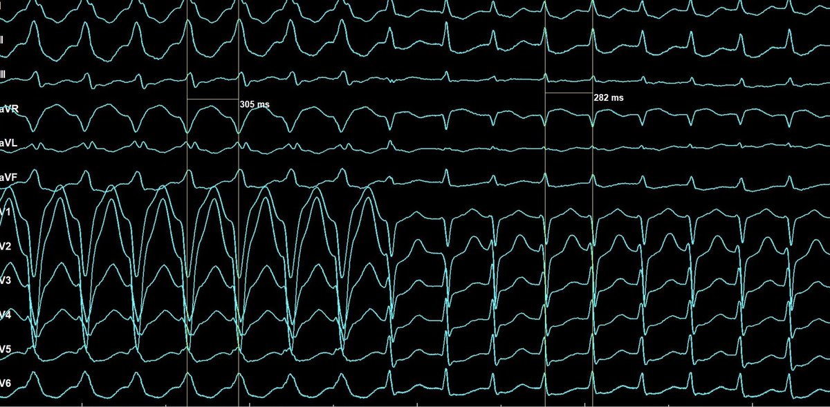 Female, 50y, Palpitations.