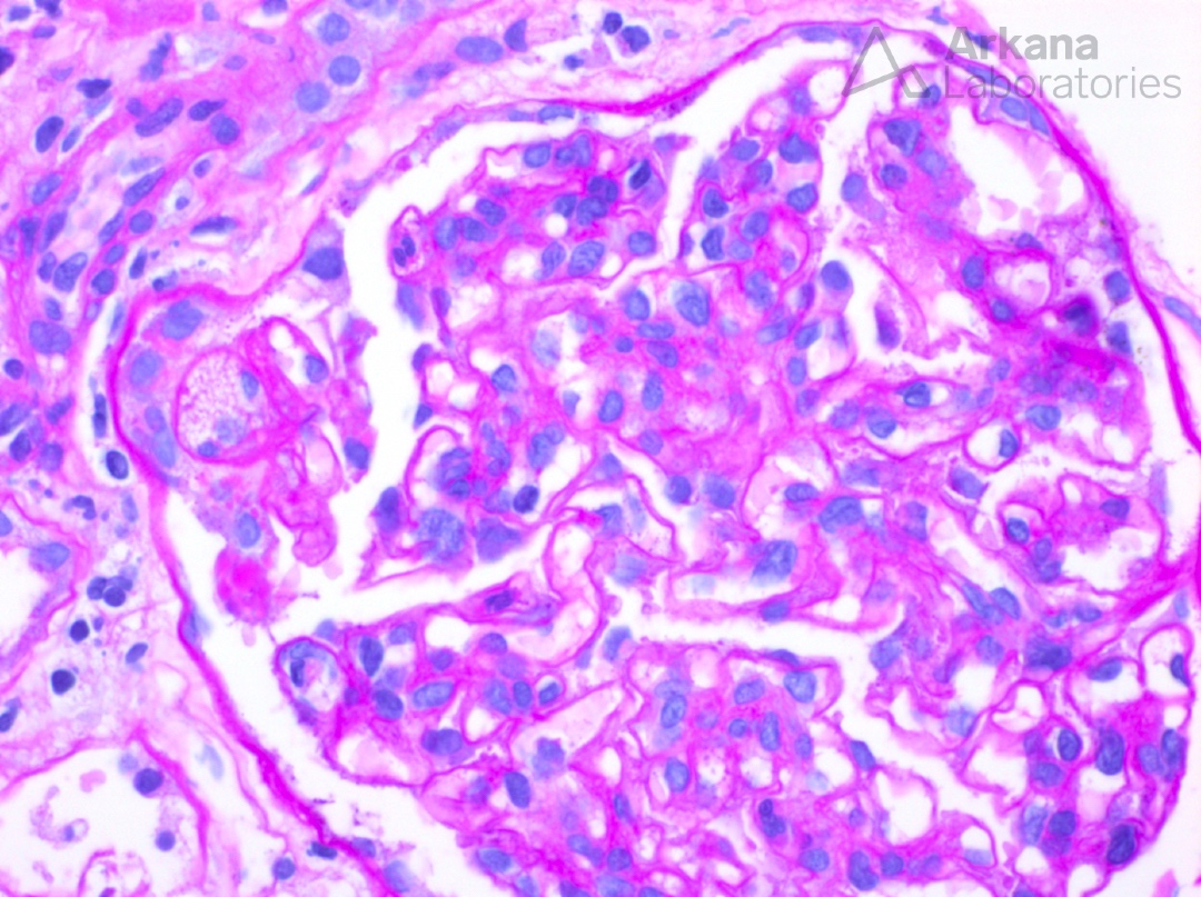 arkanalabs's tweet image. What is your diagnosis?

#DiagnoseThis #renalpath #nephropath