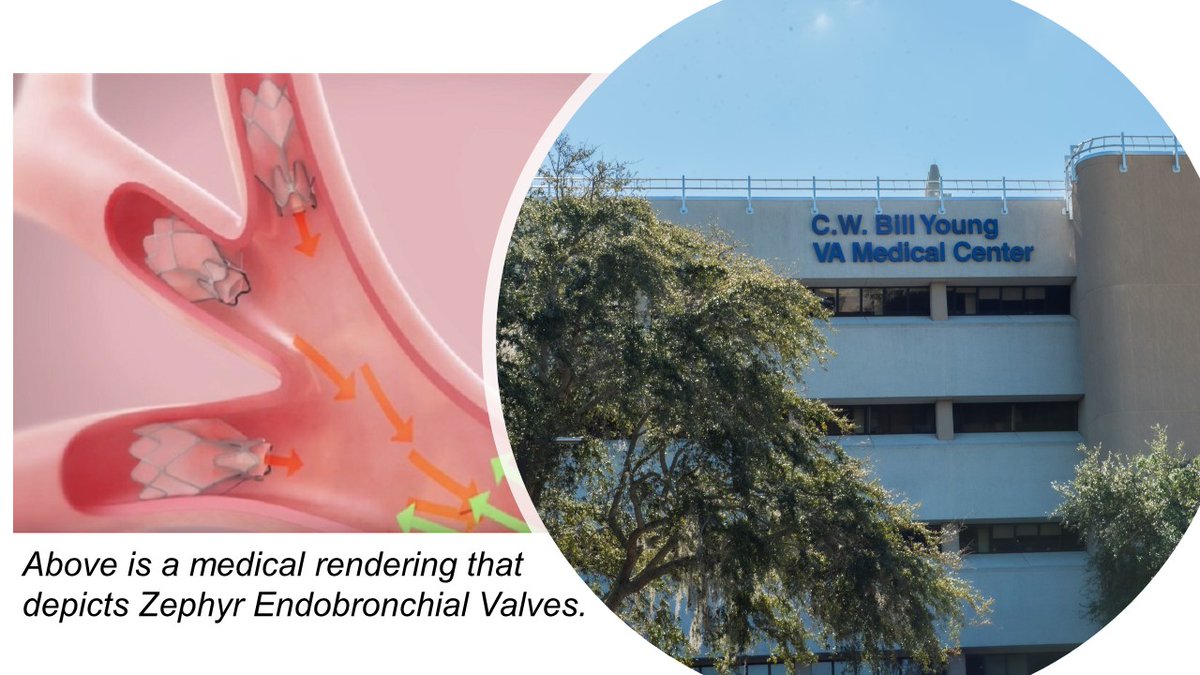 If you're a Veteran living with severe COPD, treatment is available to you via a new advancement in care: Bronschopic Lung Volume Reduction. To read more about one of Bay Pines VA's latest advancements in the patient care experience, click the link below.

va.gov/bay-pines-heal…