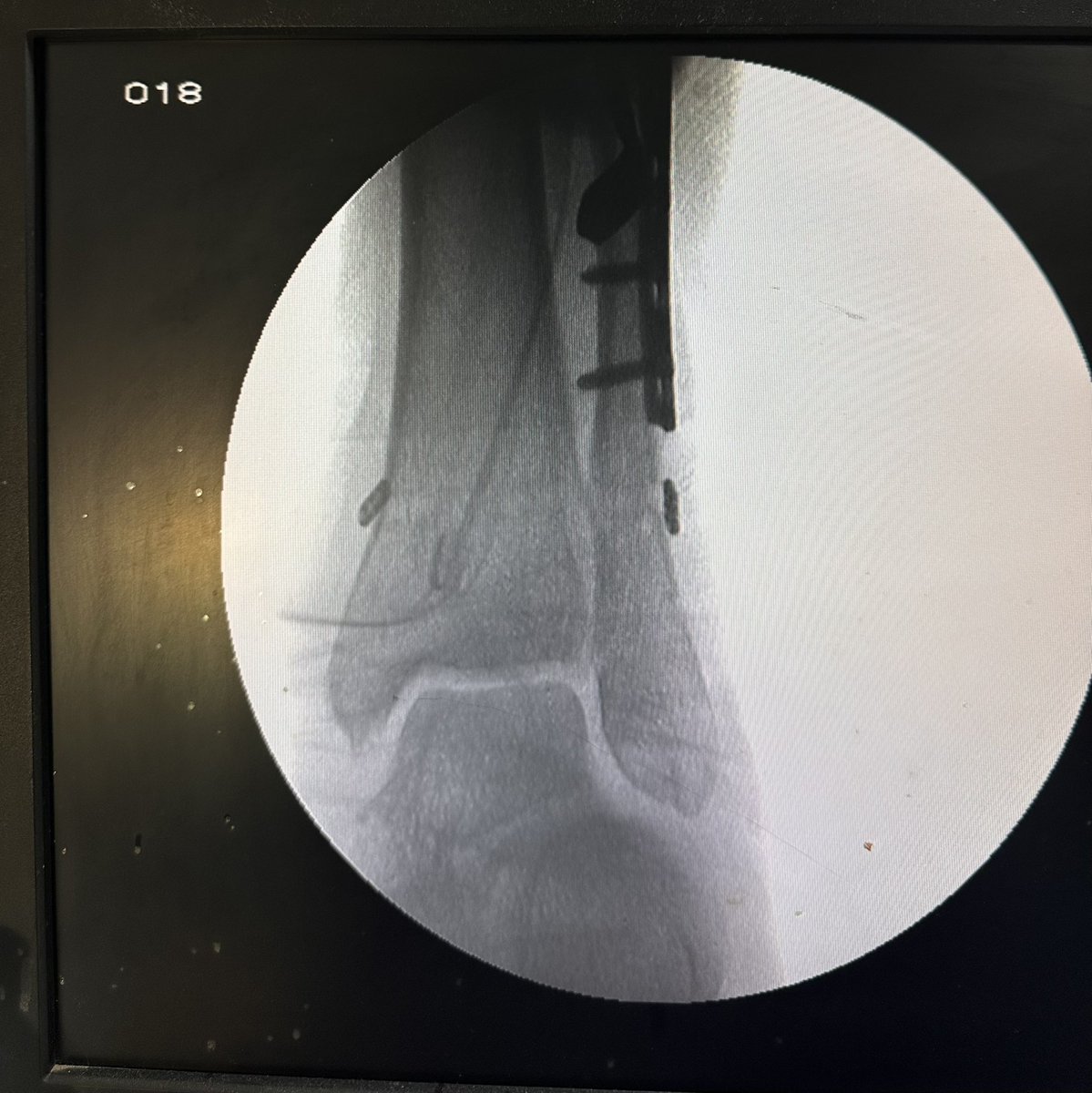 ms_keyur's tweet photo. Unstable ankle fixed by ORIF plate and TightRope.
Image 1 - instability stress test at stage 1
2- stage 2 ORIF plated still show instability 
3- xray of fibula plate full
4- Tight rope on 2 buttons woth stress test https://t.co/u07FjM6YeB