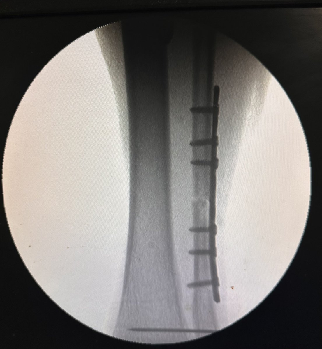 ms_keyur's tweet photo. Unstable ankle fixed by ORIF plate and TightRope.
Image 1 - instability stress test at stage 1
2- stage 2 ORIF plated still show instability 
3- xray of fibula plate full
4- Tight rope on 2 buttons woth stress test https://t.co/u07FjM6YeB