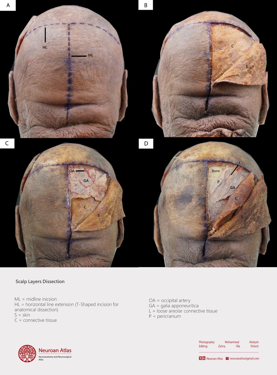Scalp Layers Dissection.

#Neuroanatomy #NeuroanAtlas