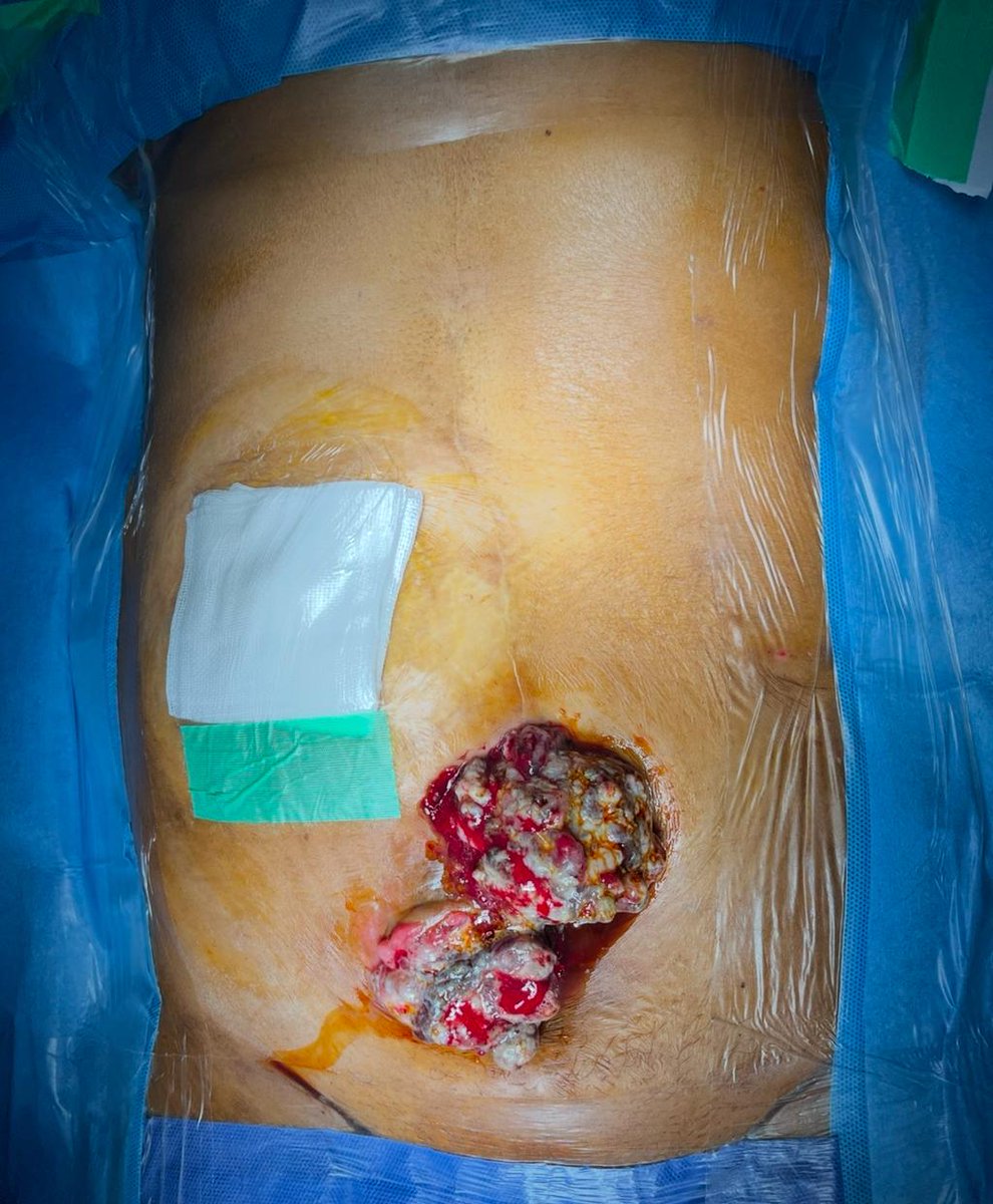 indepso's tweet photo. Recurrent PMP affects 1/3rd of operated PMP pts. 
Sometimes with very adv disease, traditional Rx is near impossible. 

Multi-visceral resection and transplant can allow Rx of  this devastating condition 

Prof @AnilV_AHEL & team at MGM hospital, Chennai in 🇮🇳 have successfully performed one

This is one of the only facilities outside Oxford/Basingstoke in 🇬🇧 and Cleveland clinic in 🇺🇸 to offer this. 

We are so proud !! 
Transplant Oncology opens new avenues for cancer patients. Great news for the 🌎 PSM community.
