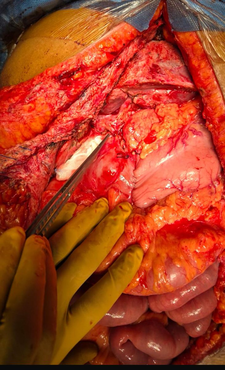 indepso's tweet photo. Recurrent PMP affects 1/3rd of operated PMP pts. 
Sometimes with very adv disease, traditional Rx is near impossible. 

Multi-visceral resection and transplant can allow Rx of  this devastating condition 

Prof @AnilV_AHEL & team at MGM hospital, Chennai in 🇮🇳 have successfully performed one

This is one of the only facilities outside Oxford/Basingstoke in 🇬🇧 and Cleveland clinic in 🇺🇸 to offer this. 

We are so proud !! 
Transplant Oncology opens new avenues for cancer patients. Great news for the 🌎 PSM community.