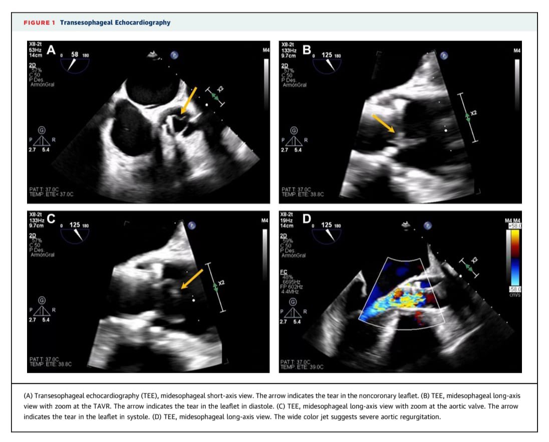 Cardiología La Paz (@cardiohulp) on Twitter photo 🙌🏼 Congratulations to our residents <a href="/Joaquin_VilaG/">Joaquín Vila</a> and <a href="/delaosa_g/">Guillermo De la Osa Hernández</a> for the publication in JACC cardiovascular interventions of this astonishing case report 👇🏻
A Torn Leaflet: An Unusual Complication of a Degenerated Transcatheter Aortic Valve Prosthesis | jacc.org/doi/10.1016/j.… 🙌🏼 Congratulations to our residents <a href="/Joaquin_VilaG/">Joaquín Vila</a> and <a href="/delaosa_g/">Guillermo De la Osa Hernández</a> for the publication in JACC cardiovascular interventions of this astonishing case report 👇🏻
A Torn Leaflet: An Unusual Complication of a Degenerated Transcatheter Aortic Valve Prosthesis | jacc.org/doi/10.1016/j.…