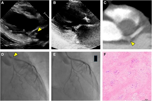 EHJ Editor-in-Chief (@ehj_ed) on Twitter photo A new Cardiovascular Flashlight describes coronary embolism in infective endocarditis.
doi.org/10.1093/eurhea…
#endocarditis #MI #cardiotwitter, <a href="/ESC_Journals/">European Society of Cardiology Journals</a>, <a href="/escardio/">European Society of Cardiology</a> A new Cardiovascular Flashlight describes coronary embolism in infective endocarditis.
doi.org/10.1093/eurhea…
#endocarditis #MI #cardiotwitter, <a href="/ESC_Journals/">European Society of Cardiology Journals</a>, <a href="/escardio/">European Society of Cardiology</a>