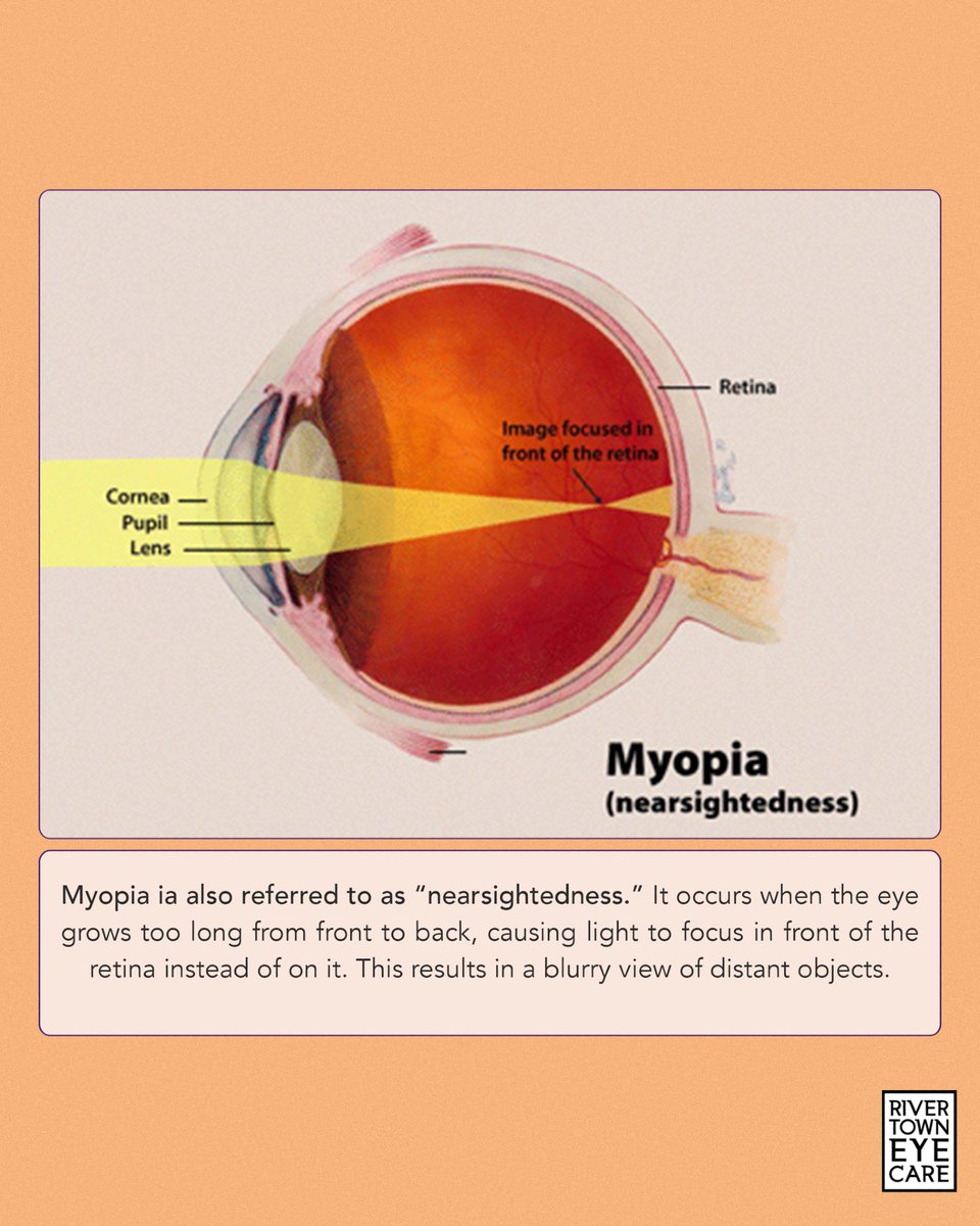 rivertowneye's tweet photo. Myopia, or nearsightedness, affects your ability to see distant objects clearly. 
We're proud to be among the select providers offering specialized Myopia Management. 

Call us today to schedule your compassionate, comprehensive eye exam! 651-437-5469 https://t.co/MedSLYDiWo