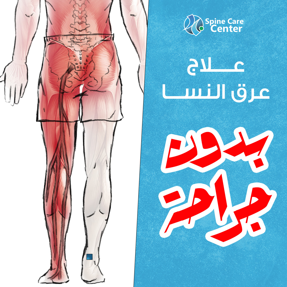 دلوقتي تخلص من عرق النسا بدون جداحة 
عن طرريق عمليات التدخل المحدود