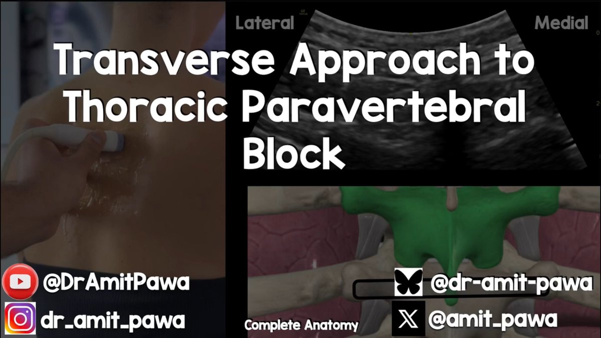 When teaching the #Paravertebral to novice practitioners, my preferred technique now is the Transverse Approach. It can be tricky to keep all the anatomy in mind, so I made a new video

#RegionalAnaesthesia #RegionalAnesthesia 

Hope you enjoy it

Link 👇🏼

youtu.be/AMHCqxP7-RU?si…