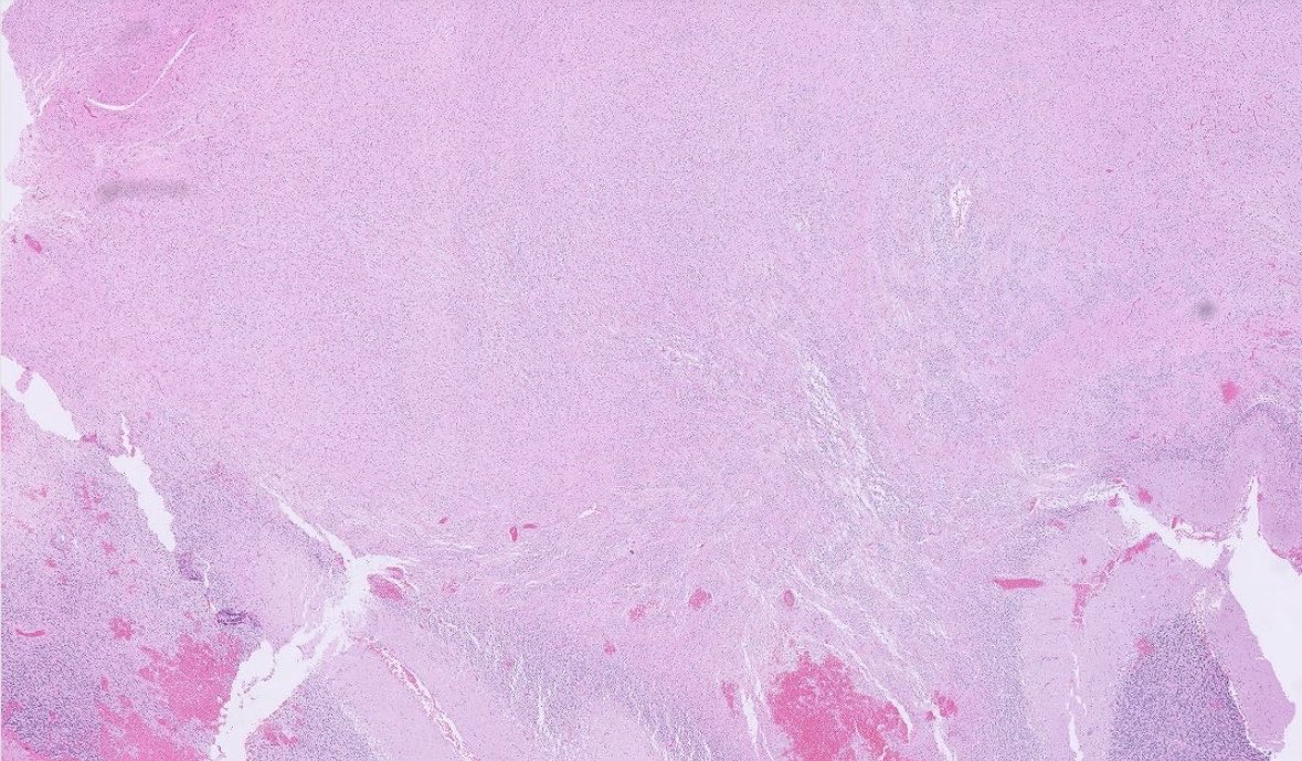 PeterKobalka's tweet image. What do you call this?  Non-enhancing 16mm lesion cerebellum, middle aged female. More pictures and poll below.
#pathx #pathtwitter #cnspath #neuropath #neuropathology