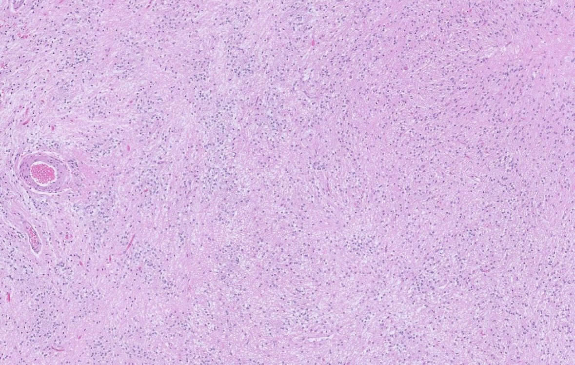 PeterKobalka's tweet image. What do you call this?  Non-enhancing 16mm lesion cerebellum, middle aged female. More pictures and poll below.
#pathx #pathtwitter #cnspath #neuropath #neuropathology
