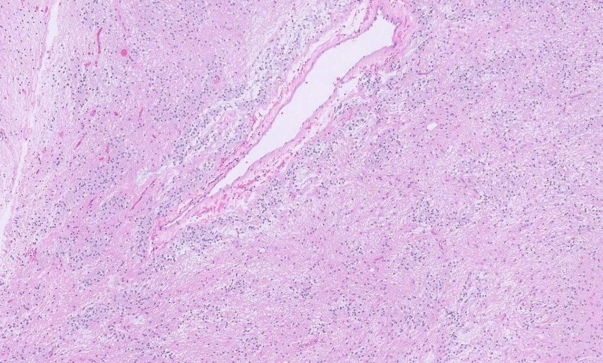 PeterKobalka's tweet image. What do you call this?  Non-enhancing 16mm lesion cerebellum, middle aged female. More pictures and poll below.
#pathx #pathtwitter #cnspath #neuropath #neuropathology