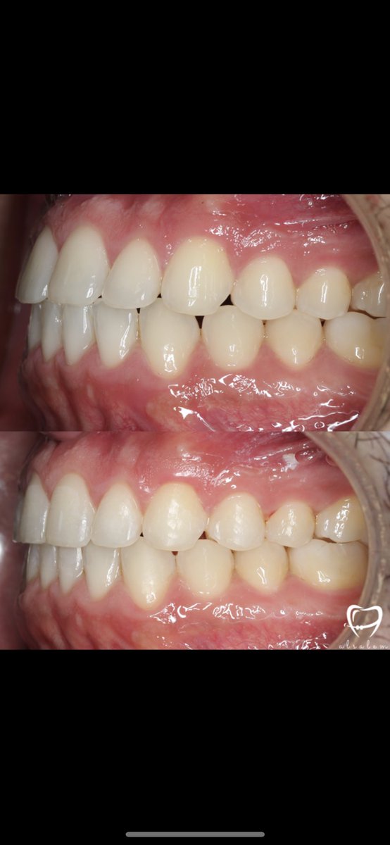 تخفيف بروز الأسنان باستخدام التقويم الشفاف انفزلاين.