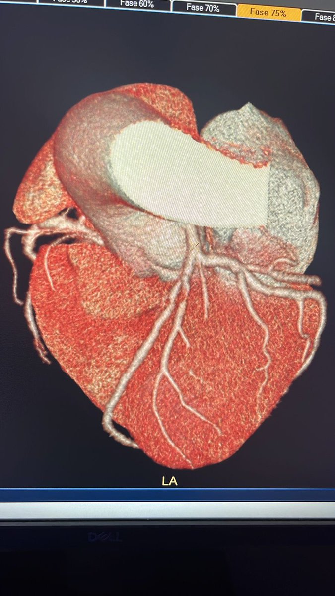 Dr. Ángel G. Nájera Albarrán (@angna_86) on Twitter photo 🧔🏾67y CP 3hrs. What do you think? 🇲🇽 #Cardiology #EKG #MedTwitter #CardioTwitter #PCI #complexpci <a href="/mornei2011/">Neisser M</a> <a href="/BotCardiology/">Cardiology Bot</a> <a href="/EkgHacks/">ECG.Hacks</a> <a href="/smithECGBlog/">Stephen W. Smith</a> <a href="/IC_SIAC/">Intervencionismo Cardiovascular SIAC</a> <a href="/EM_RESUS/">Sam Ghali, M.D.</a> <a href="/PCRonline/">PCRonline 🫀</a> <a href="/SOCiME_/">SOCiME</a> <a href="/ecgandrhythmRoe/">Dr. Andreas Roeschl</a> <a href="/marioalrb84_a/">Dr. tocino</a> <a href="/akbarul/">akbar haq</a> <a href="/HiramSalas13/">Hiram Salas Elric</a> <a href="/ShariqShamimMD/">Dr Shariq Shamim</a> <a href="/cardioelihu/">🇲🇽 Elihu Durán 🇲🇽</a> 🧔🏾67y CP 3hrs. What do you think? 🇲🇽 #Cardiology #EKG #MedTwitter #CardioTwitter #PCI #complexpci <a href="/mornei2011/">Neisser M</a> <a href="/BotCardiology/">Cardiology Bot</a> <a href="/EkgHacks/">ECG.Hacks</a> <a href="/smithECGBlog/">Stephen W. Smith</a> <a href="/IC_SIAC/">Intervencionismo Cardiovascular SIAC</a> <a href="/EM_RESUS/">Sam Ghali, M.D.</a> <a href="/PCRonline/">PCRonline 🫀</a> <a href="/SOCiME_/">SOCiME</a> <a href="/ecgandrhythmRoe/">Dr. Andreas Roeschl</a> <a href="/marioalrb84_a/">Dr. tocino</a> <a href="/akbarul/">akbar haq</a> <a href="/HiramSalas13/">Hiram Salas Elric</a> <a href="/ShariqShamimMD/">Dr Shariq Shamim</a> <a href="/cardioelihu/">🇲🇽 Elihu Durán 🇲🇽</a>