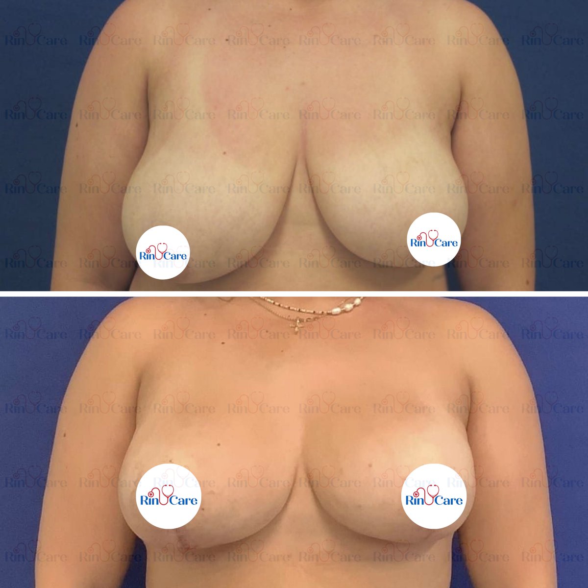 rinucare's tweet photo. #BreastLift #BreastLiftSurgery #Mastopexy #BreastAugmentation #CosmeticSurgery #BodyContouring #BreastEnhancement #PlasticSurgeryGoals #BreastTransformation #NaturalLookSurgery #BreastLiftTurkey #PlasticSurgeryTurkey #CosmeticTourismTurkey #BreastSurgeryIstanbul https://t.co/MCyLpJ9pLC