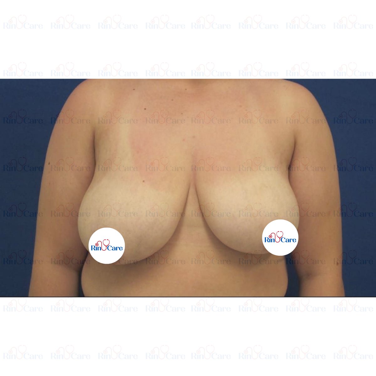 rinucare's tweet photo. #BreastLift #BreastLiftSurgery #Mastopexy #BreastAugmentation #CosmeticSurgery #BodyContouring #BreastEnhancement #PlasticSurgeryGoals #BreastTransformation #NaturalLookSurgery #BreastLiftTurkey #PlasticSurgeryTurkey #CosmeticTourismTurkey #BreastSurgeryIstanbul https://t.co/MCyLpJ9pLC