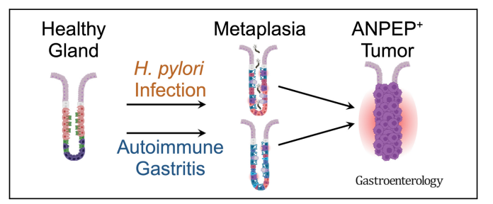 1/ 🚨 Revelaciones clave sobre gastritis y cáncer gástrico: "Unveiling Cancer-Related Metaplastic Cells in Both Helicobacter pylori Infection and Autoimmune Gastritis", publicado en <a href="/AGA_Gastro/">Gastroenterology</a> (gastrojournal.org/article/S0016-…), Autores: Stella G. Hoft (Saint Louis University) y col 🧵