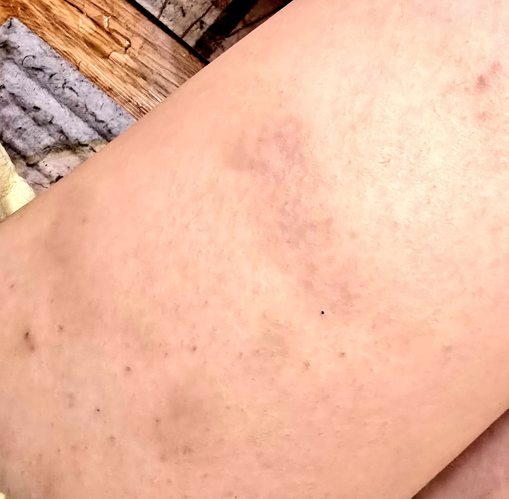 sharkiegillz's tweet photo. thumbs up to belt for bruising sh bruisetwt shtwt 988twt ouchietwt https://t.co/dFTsmew9fz