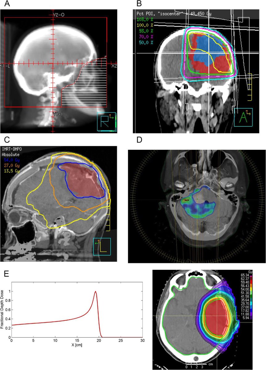 Connor Kinslow, MD (@radoncconnor) on Twitter photo Honored to have the privilege of writing this review article with Dr. Minesh Mehta of <a href="/NRGonc/">NRG Oncology</a> & <a href="/MiamiCancerInst/">Miami Cancer Institute Research</a>
"Future Directions in the Treatment of Low-Grade Gliomas"
<a href="/ColumbiaRadOnc/">Columbia RadOnc</a>
journals.lww.com/journalppo/ful… Honored to have the privilege of writing this review article with Dr. Minesh Mehta of <a href="/NRGonc/">NRG Oncology</a> & <a href="/MiamiCancerInst/">Miami Cancer Institute Research</a>
"Future Directions in the Treatment of Low-Grade Gliomas"
<a href="/ColumbiaRadOnc/">Columbia RadOnc</a>
journals.lww.com/journalppo/ful…