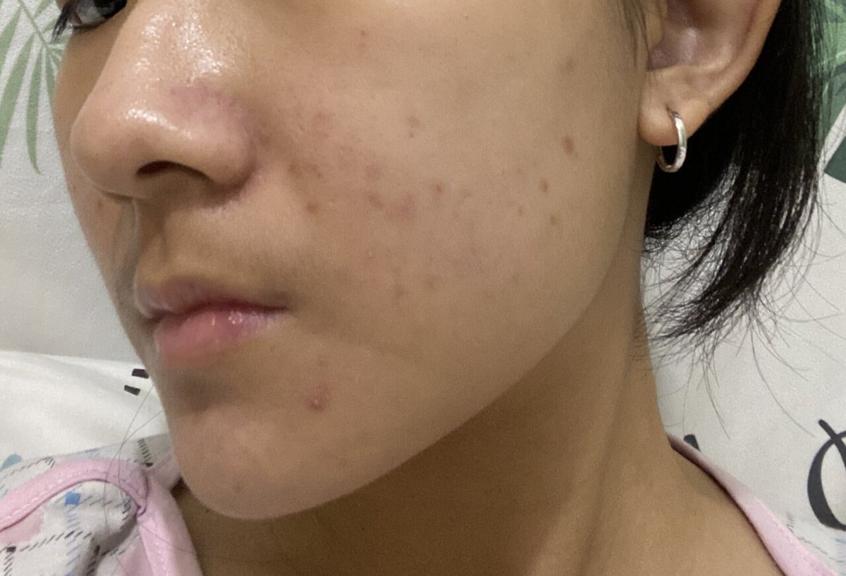 [bb] TW // JERAWAT

haii ada yg pernah kyk aku gk yaa?? banyak pie pih dan jerawat di pipi.. ada yg tau ga ya ini kenapaa atau ada rekomendasi skincare? siapa tau ada yg pernah ngalaminn.. makasihh