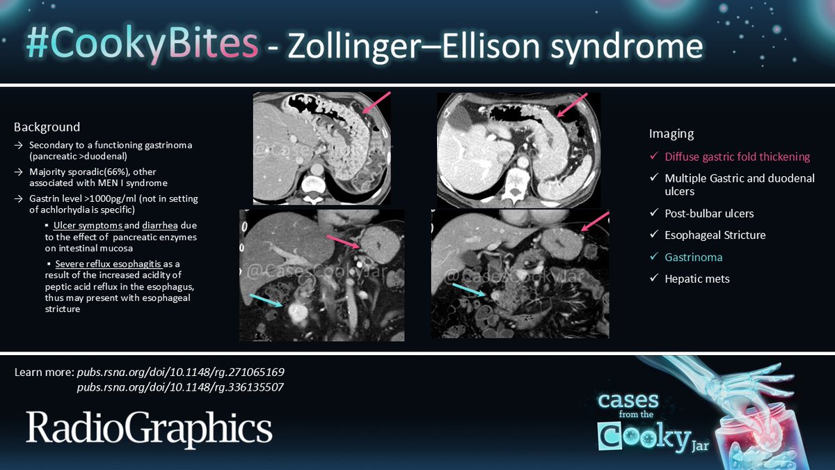 Cases From the Cooky Jar (@casescookyjar) on Twitter photo Answer: Zollinger–Ellison syndrome
Learn more: 🔗pubs.rsna.org/doi/10.1148/rg…
🔗pubs.rsna.org/doi/10.1148/rg…
#CookyBites #200 #RGphx <a href="/cookyscan1/">Cooky Menias</a> <a href="/RadioGraphics/">RadioGraphics</a> Answer: Zollinger–Ellison syndrome
Learn more: 🔗pubs.rsna.org/doi/10.1148/rg…
🔗pubs.rsna.org/doi/10.1148/rg…
#CookyBites #200 #RGphx <a href="/cookyscan1/">Cooky Menias</a> <a href="/RadioGraphics/">RadioGraphics</a>