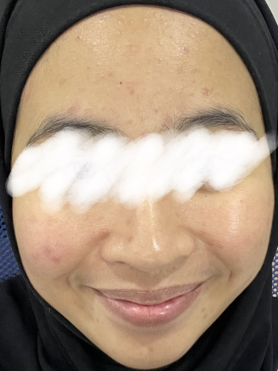 ezzaazaidi's tweet photo. Honest talk about Swimming Pool Toner from Eqqualberry ✨ 

IM OBSESSED WITH THIS TONER! Srs girl, dkt MY ni masih tak ramai guna this toner! Jom kita viralkan sesama. Siapa yang ada skin texture or bumpy skin, hear me out …. 👂 https://t.co/tM6WiW1LFh