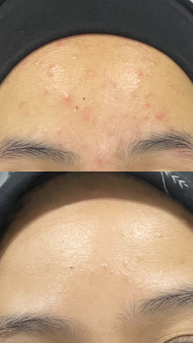 ezzaazaidi's tweet photo. Toner ni bagus gila! Toner exfoliator yang paling gentle to skin yg i prnh pakai. Safe untuk preggy, BF mom, TTC &amp; sensitive skin. Toner ni contain enzyme namanya protese yang works mcm AHA/BHA, tanpa break down your skin. Tengok my skin texture, in 1 mth. Amazing kan?! https://t.co/n7XlDb5aaq